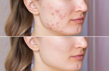 truly clear before-after-2