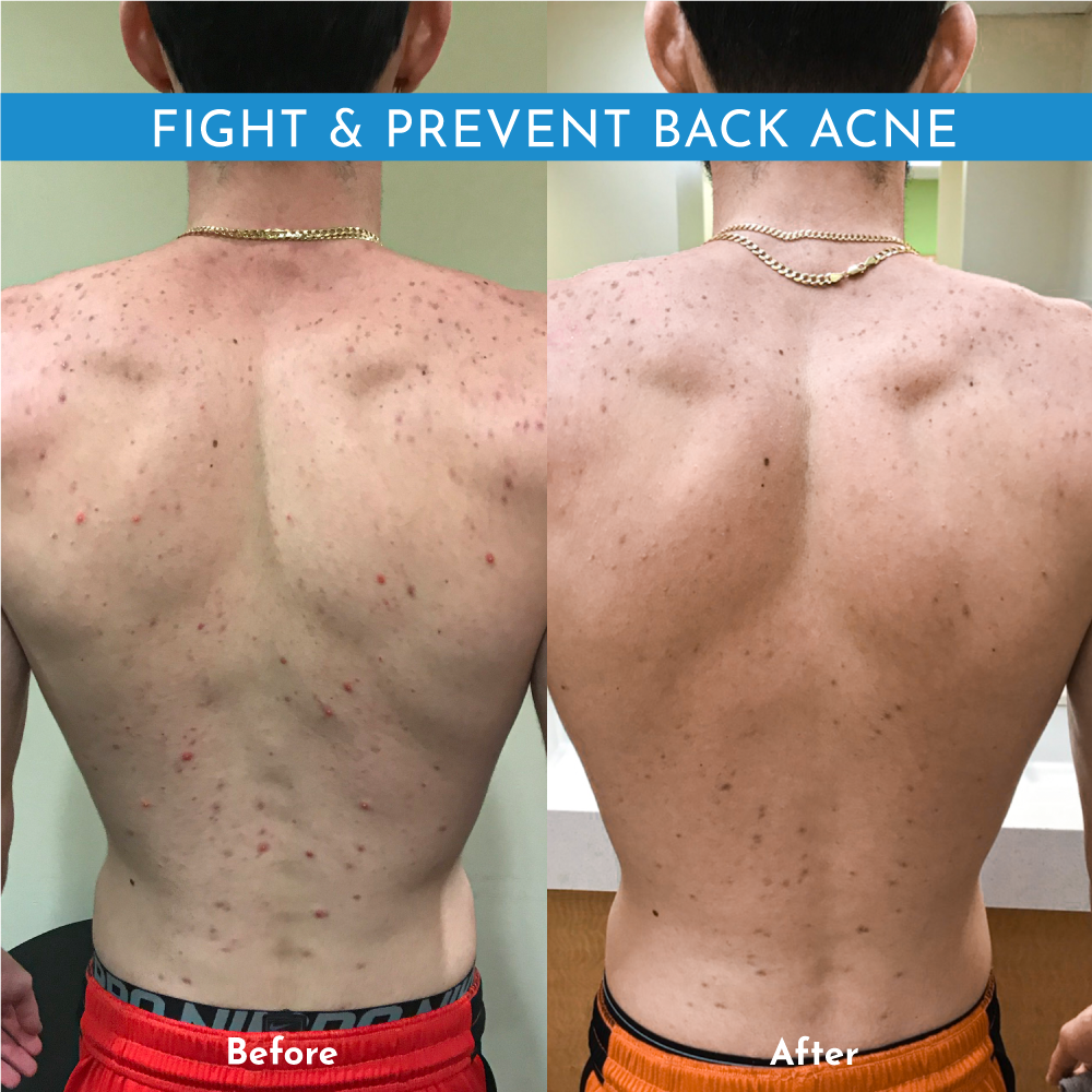 Truly Clear Acne Bar - Stops Acne