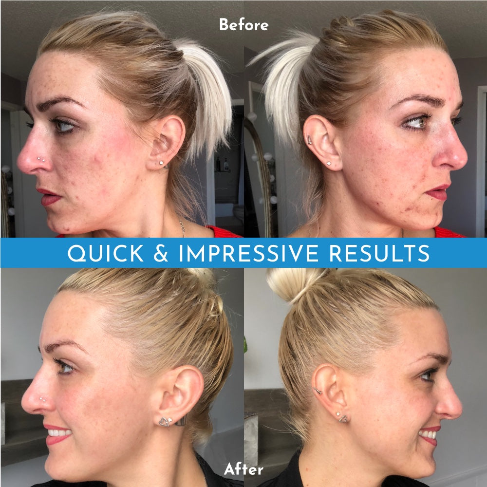 Truly Clear Acne Bar - Stops Acne