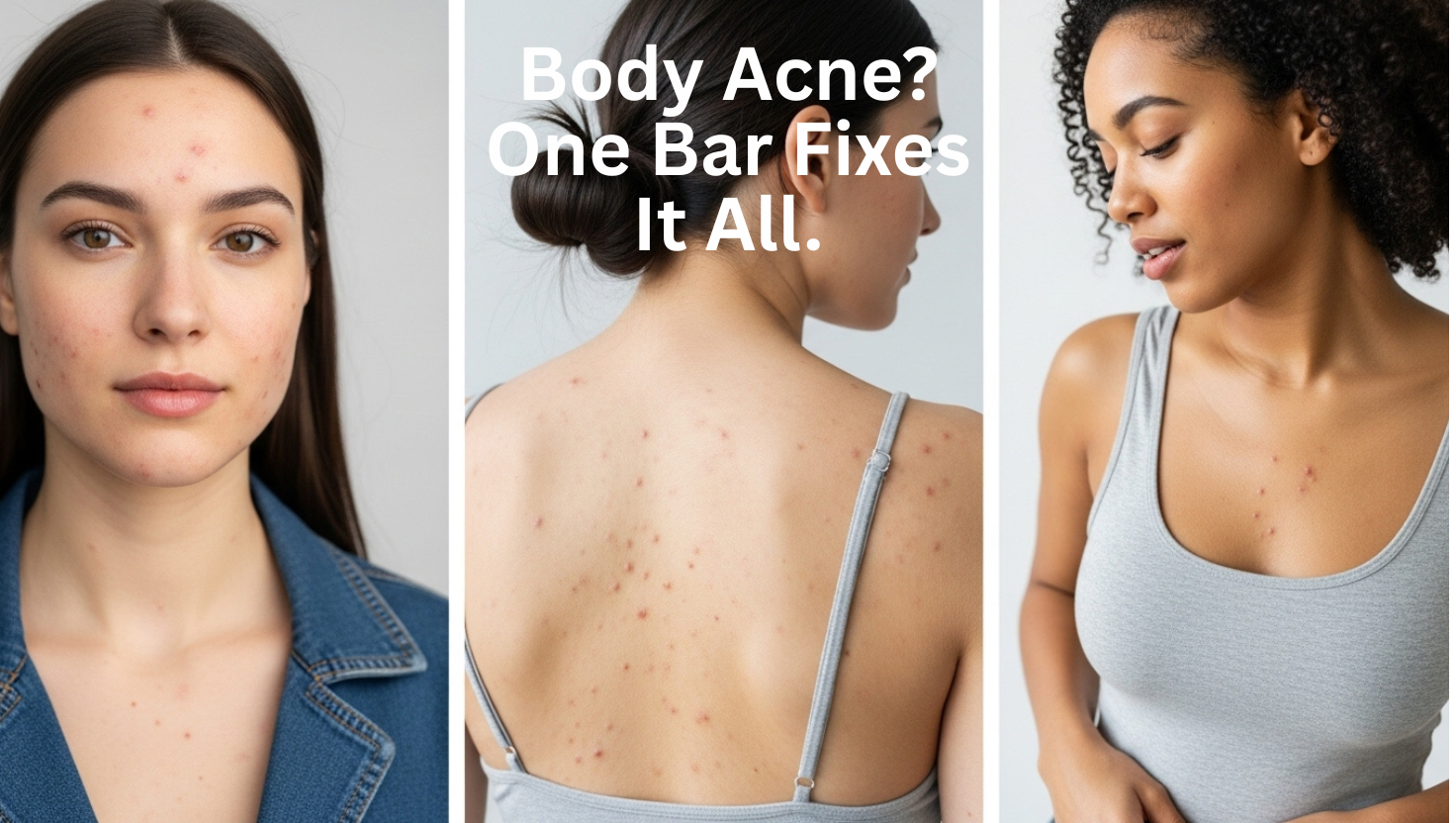 Why Body Acne Gets Ignored — and How the Truly Clear Acne Bar Fixes It (Face, Chest, Back, Butt)