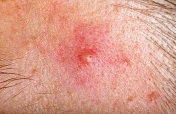 Truly Clear cystic acne