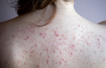 Truly Clear heals cystic acne