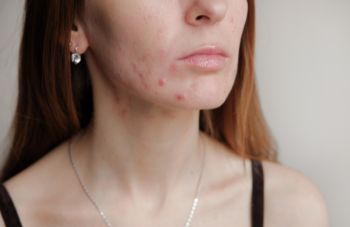 Truly Clear relieves chin acne