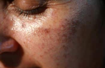 Truly Clear sun and acne