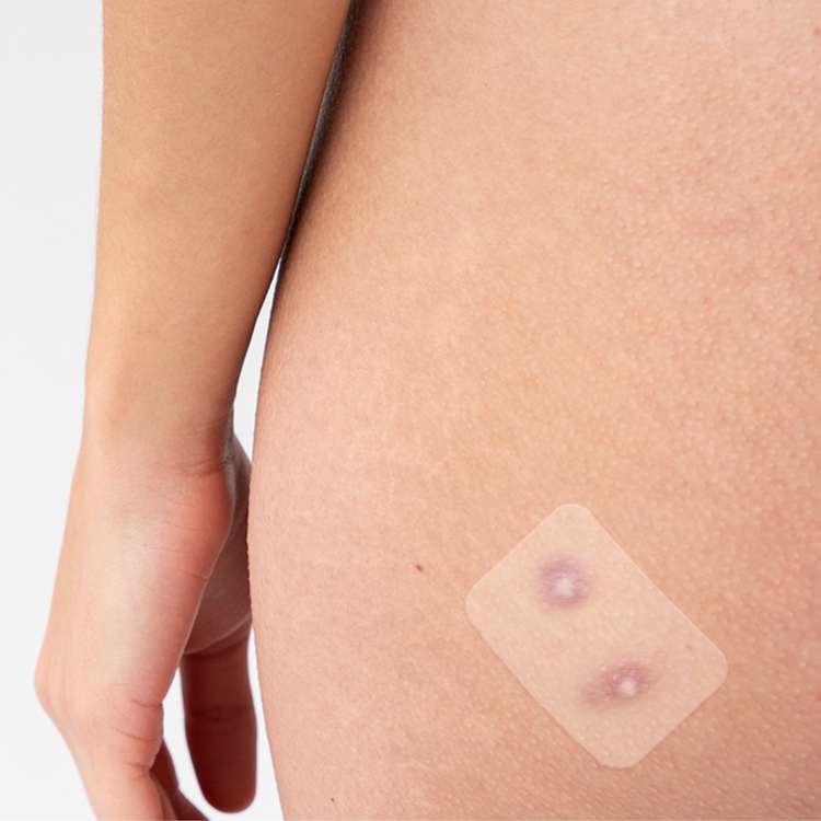5 Surprising Benefits of Using Pimple Patches for Acne-Prone Skin ...