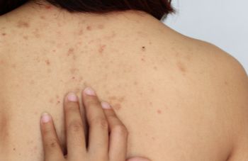 clear back acne with Truly Clear