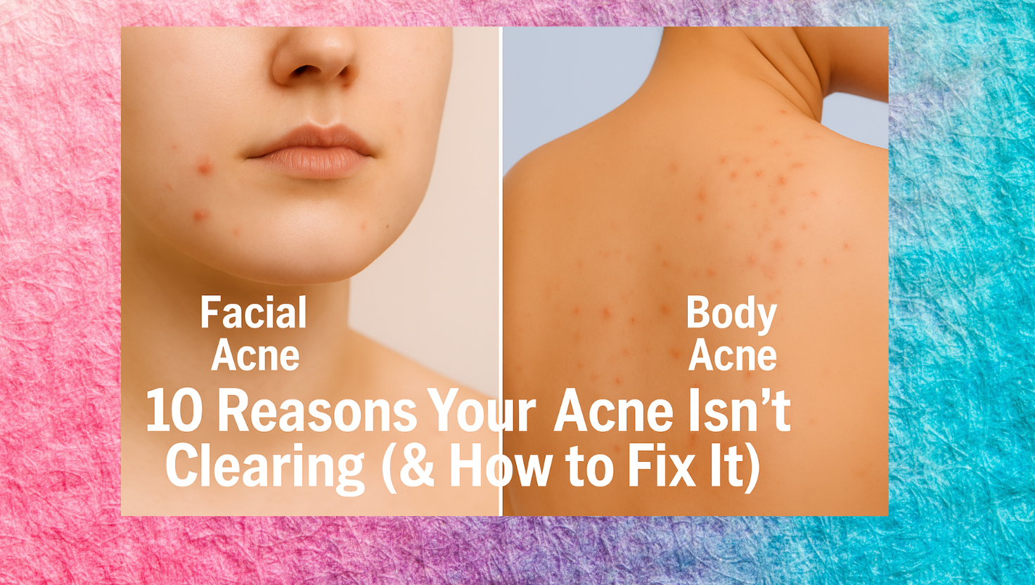 10 Reasons Your Acne Isn’t Clearing (& How to Fix It)