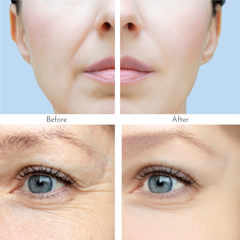 Truly Clear Wrinkle Fighting Hyaluronic Patches 2-Pack