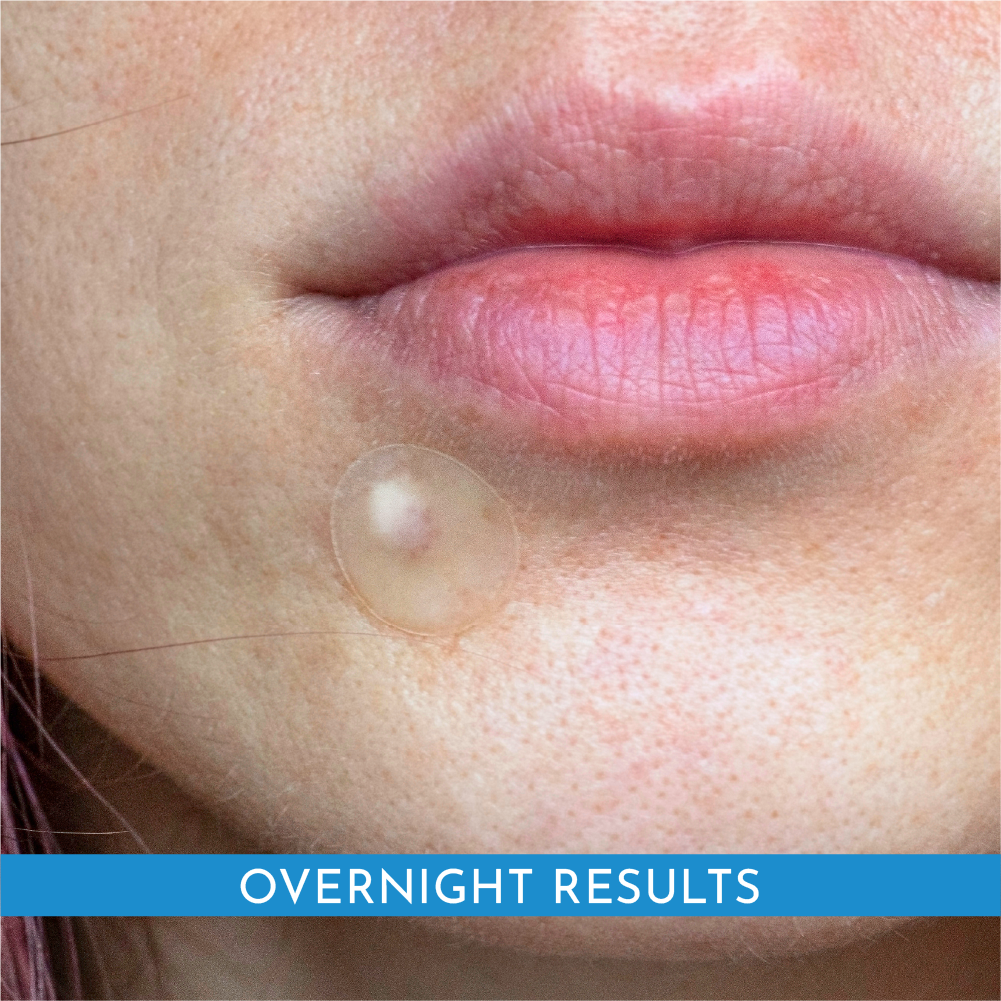 Truly Clear Hydrocolloid Acne Patches