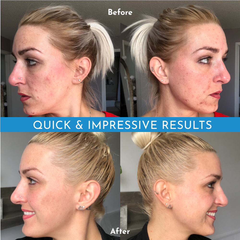 Truly Clear One Step Acne Bar Travel Set